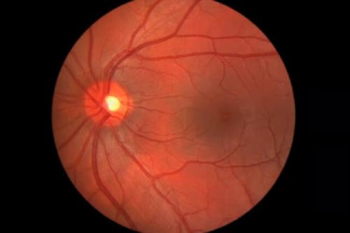 نتایج امیدوارکننده یک روش جدید ژن درمانی برای بازگرداندن بینایی