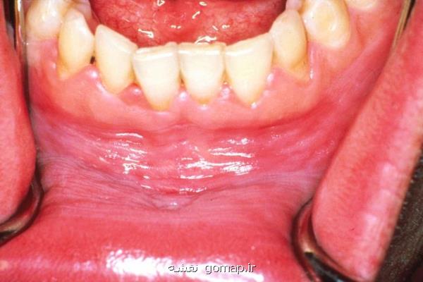 تولید چسب مخاطی كوركومین برای درمان ضایعات زخمی لیكن پلان دهانی