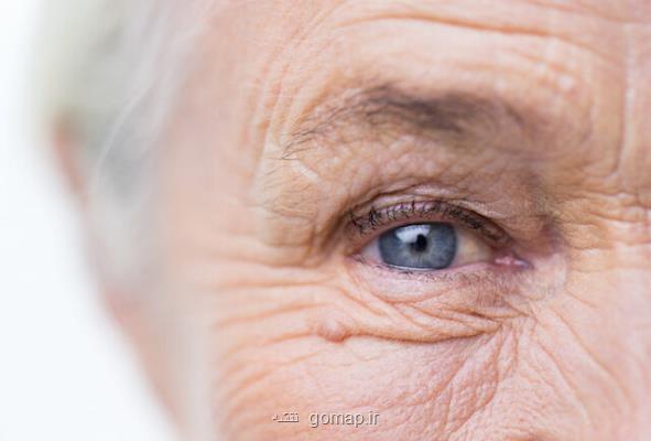 پیشبینی خطر بروز آلزایمر با بررسی مردمك چشم